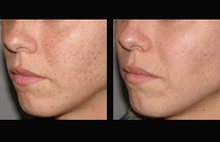 IPL Lumenis M22 (luz pulsada intensa)